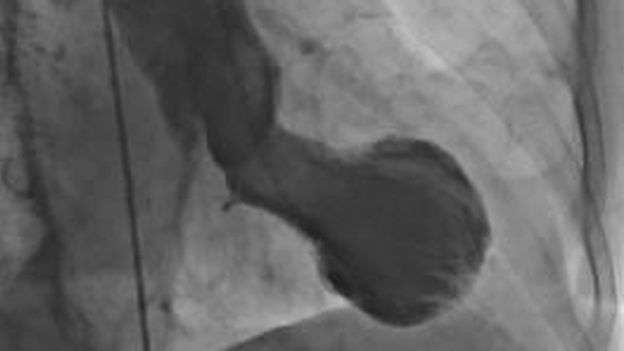  اسکن قلب مبتلا به تاکوتسوبو، شکل غیر طبیعی آن را نشان می‌دهد 